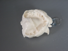 proteza zębowa - akrylowa